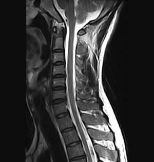 頸 部 mri で わかる 病気