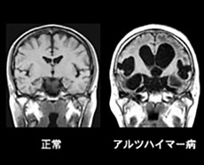 あなたの物忘れは歳のせい？